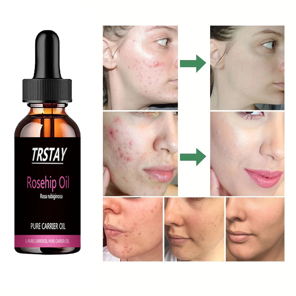 TRSTAY Organic Rosehip Seed Oil 100% Natural Anti Aging Treatment For Face Skin